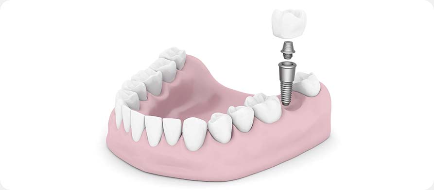 SW Calgary Dental Crown Implants | West Peaks Dental Suite | General & Family Dentist | SW Calgary