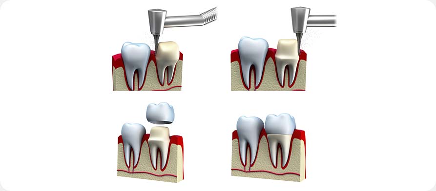 SW Calgary Dental Crowns | West Peaks Dental Suite | General & Family Dentist | SW Calgary