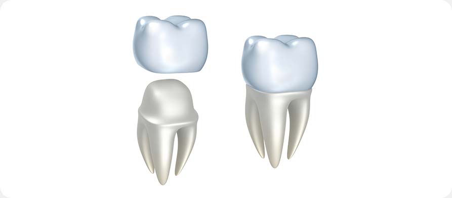 SW Calgary Dental Crowns | West Peaks Dental Suite | General & Family Dentist | SW Calgary