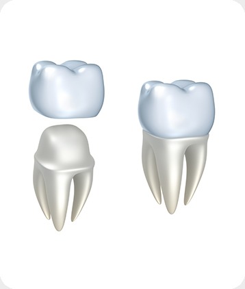 SW Calgary Dental Crowns | West Peaks Dental Suite | General & Family Dentist | SW Calgary