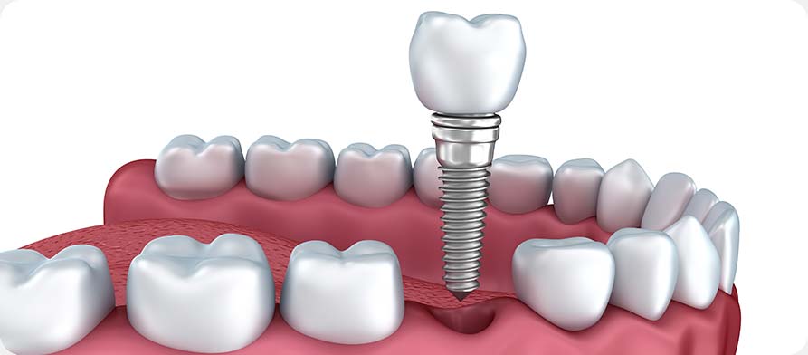SW Calgary Dental Implants | West Peaks Dental Suite | General & Family Dentist | SW Calgary