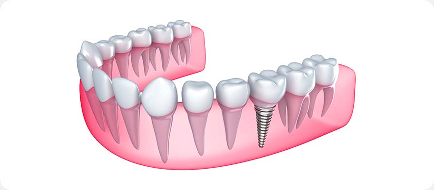 SW Calgary Dental Implants | West Peaks Dental Suite | General & Family Dentist | SW Calgary