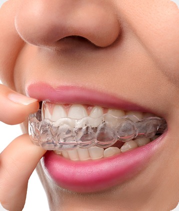 SW Calgary Invisalign® | West Peaks Dental Suite | General & Family Dentist | SW Calgary