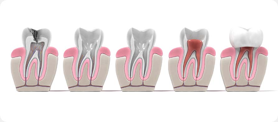 SW Calgary Root Canal Therapy | West Peaks Dental Suite | General & Family Dentist | SW Calgary