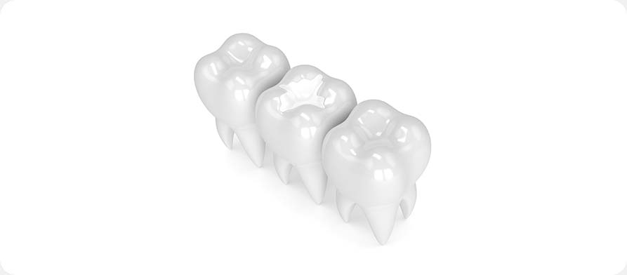 SW Calgary Tooth Coloured Fillings | West Peaks Dental Suite | General & Family Dentist | SW Calgary