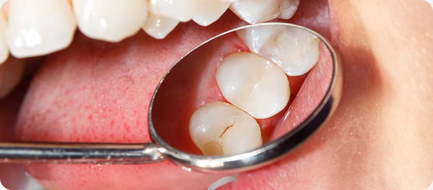 SW Calgary Tooth Coloured Fillings | West Peaks Dental Suite | General & Family Dentist | SW Calgary