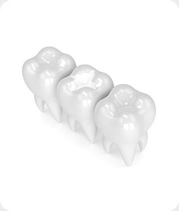 SW Calgary Tooth Coloured Fillings | West Peaks Dental Suite | General & Family Dentist | SW Calgary